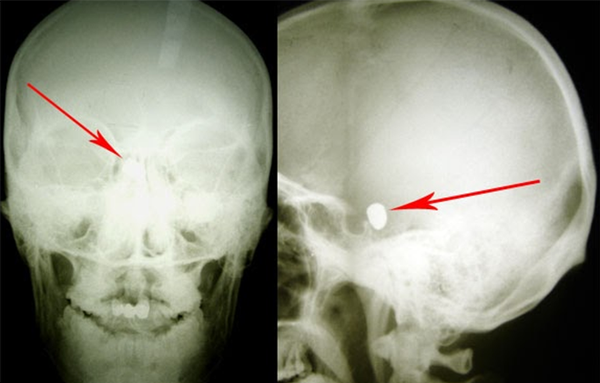 Пуля в голове: нейрохирург провел в Молдове уникальную операцию - Sputnik Молдова