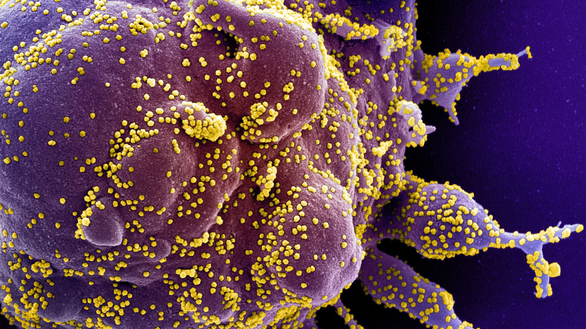 Une cellule infectée par des particules virales du SRAS-CoV-2 (en jaune) - Sputnik Moldova, 1920, 02.01.2022