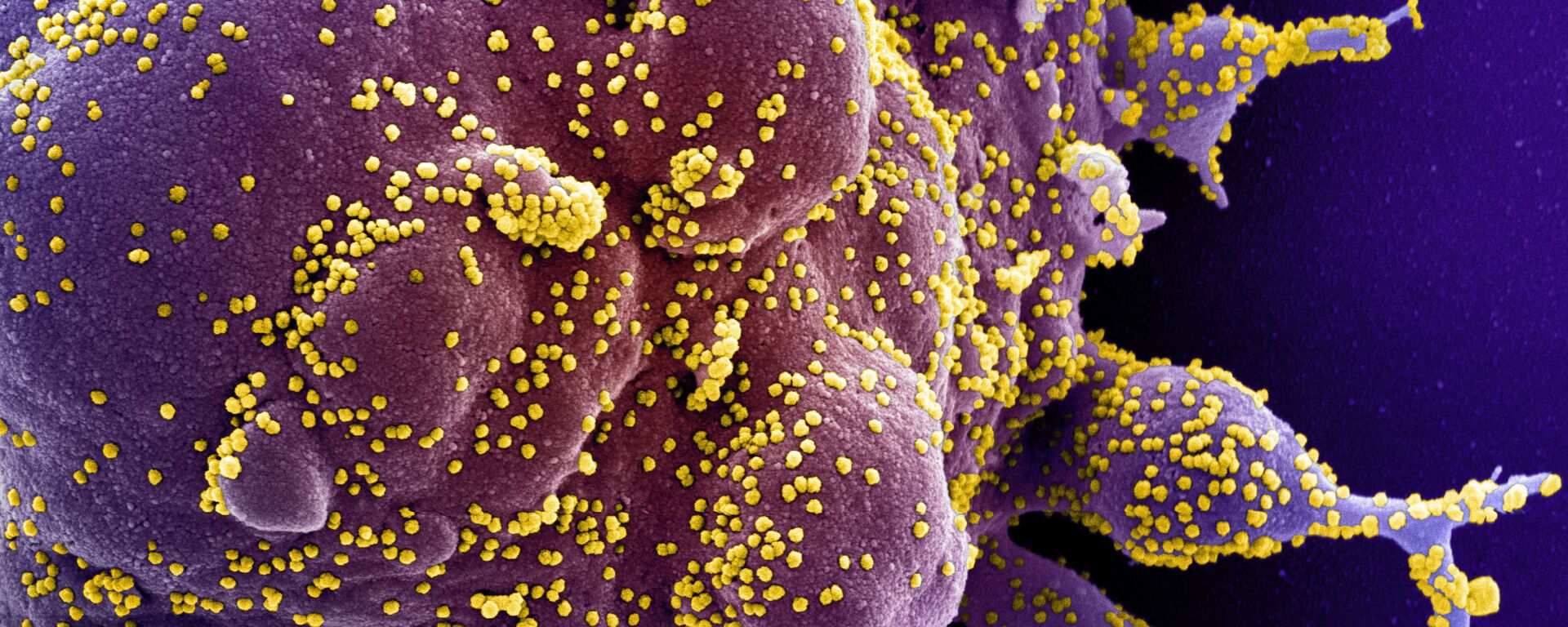 Une cellule infectée par des particules virales du SRAS-CoV-2 (en jaune) - Sputnik Moldova-România, 1920, 13.01.2022