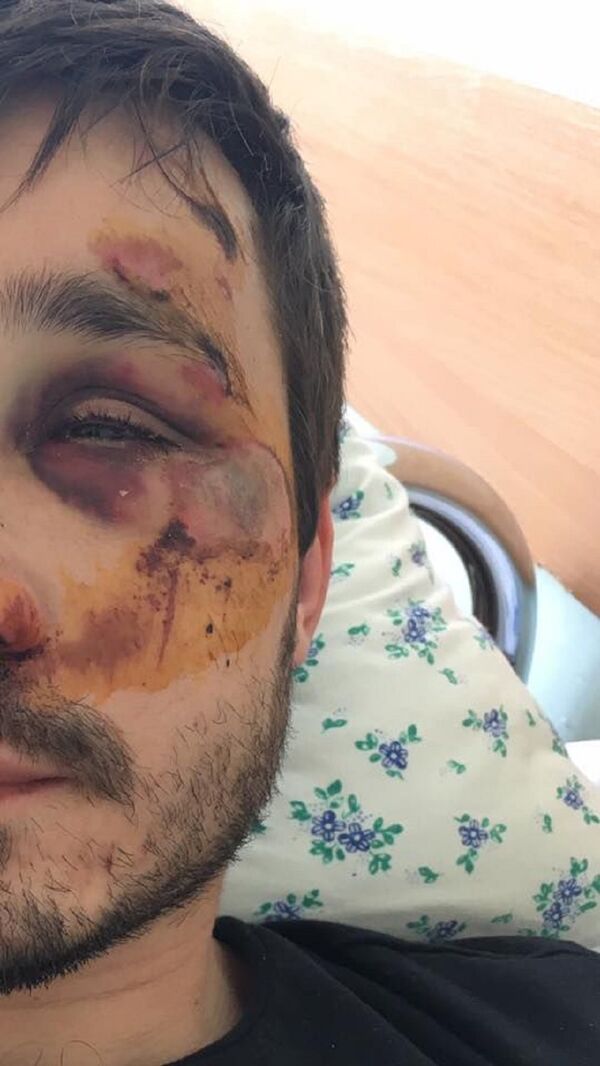 Лицо молодого человека, подвергшегося избиению в Кишиневе - Sputnik Moldova