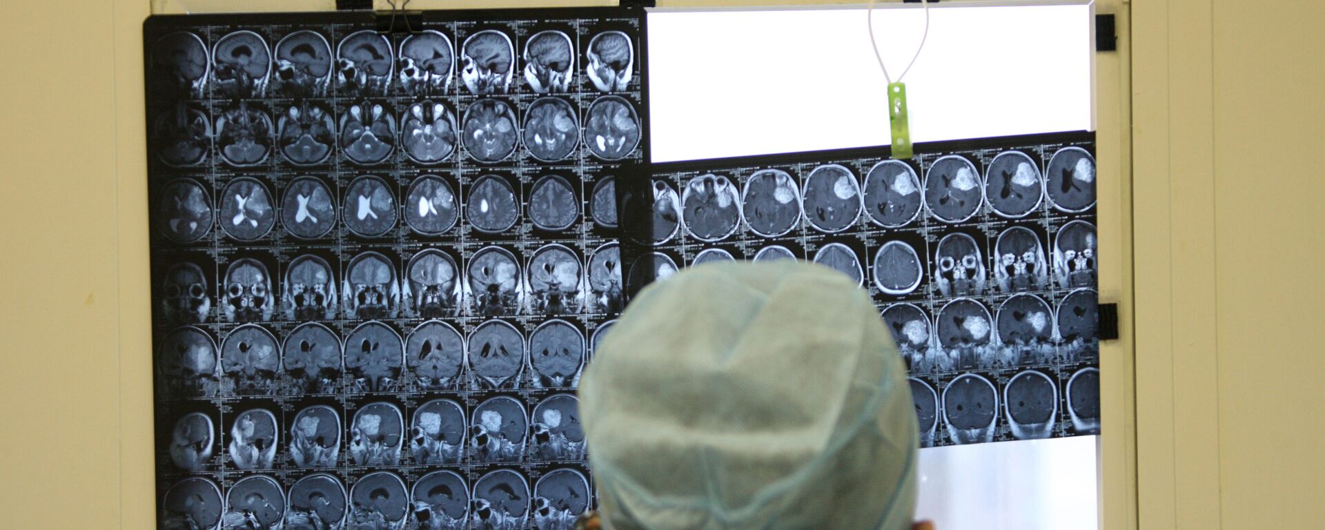 Врач смотрит на рентген снимки мозга. Архивное фото - Sputnik Молдова, 1920, 06.08.2020