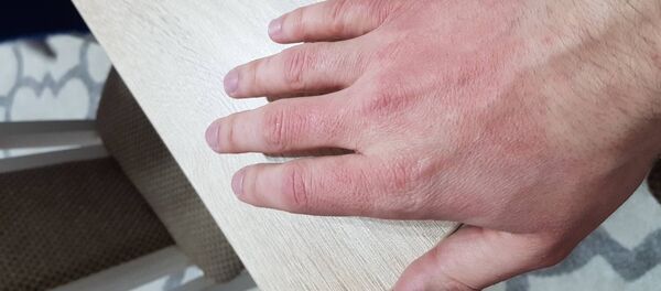 Folosirea în exces a dezinfectantului provoacă iritații ale pielii Folosirea în exces a dezinfectantului provoacă iritații ale pielii - Sputnik Молдова